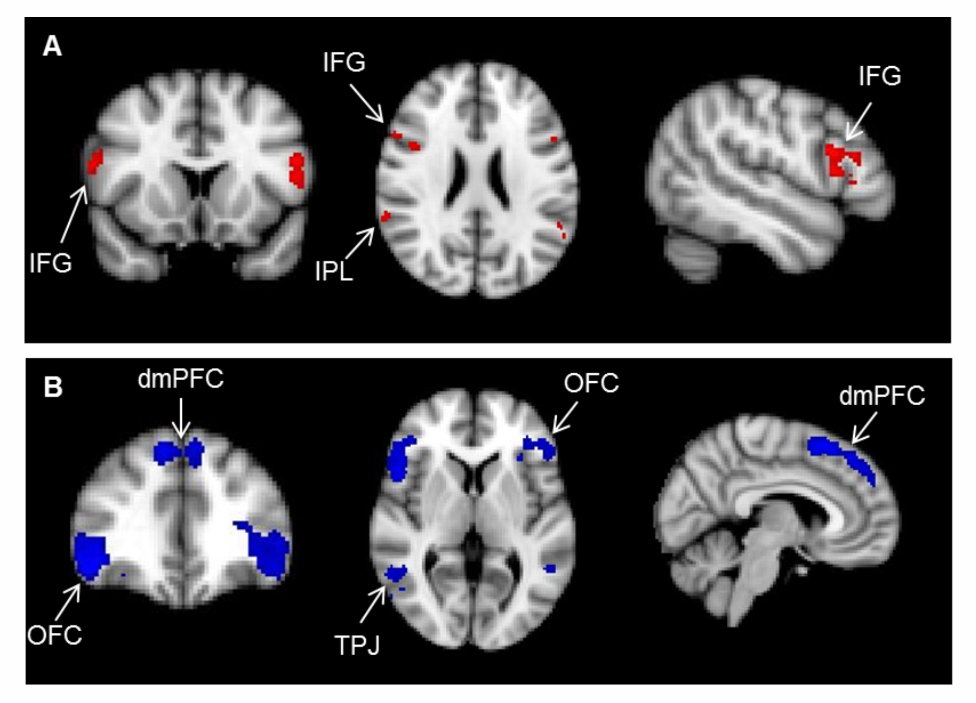 mirror system and mentalising system areas shown on 3 brain slices